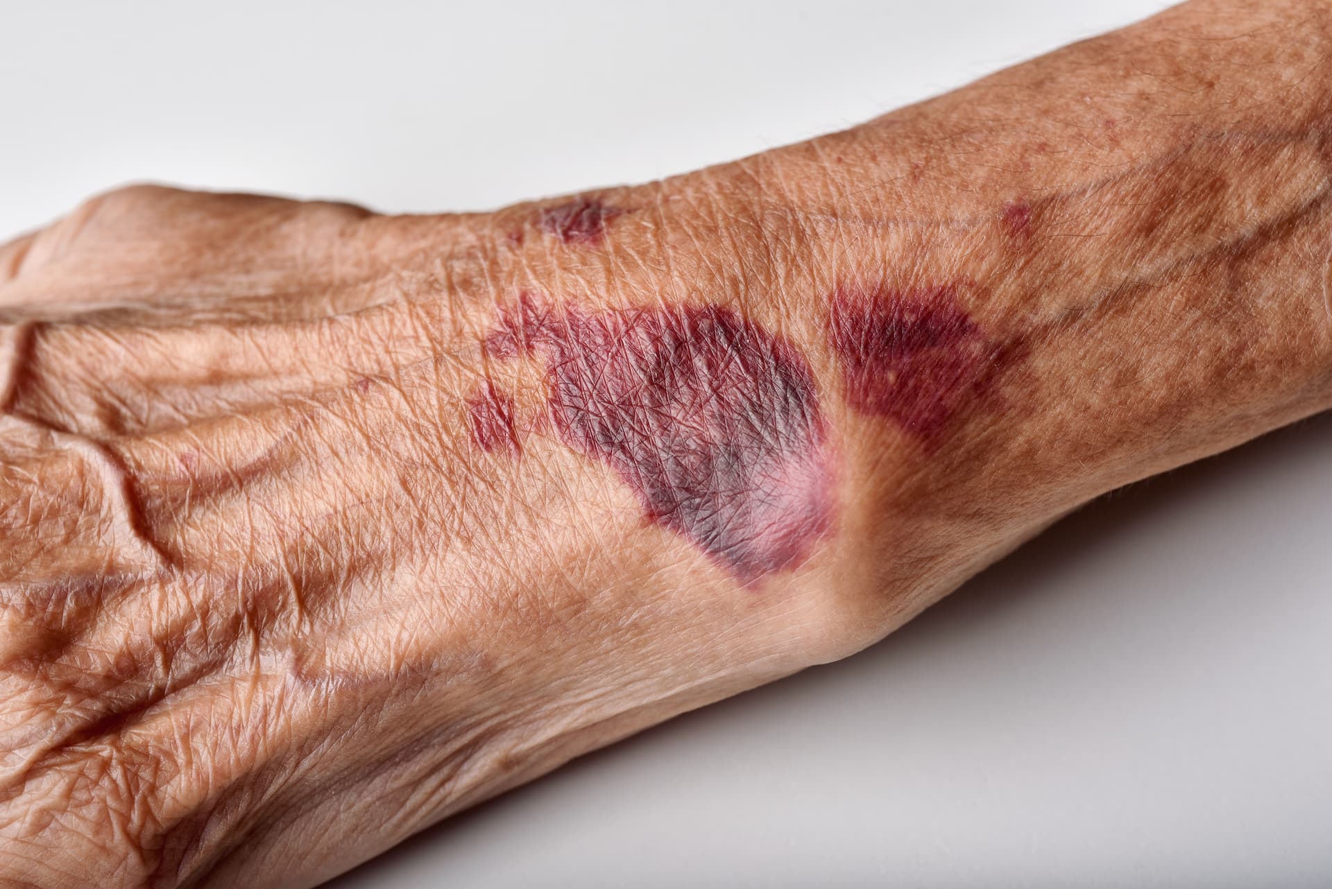 Elder Abuse